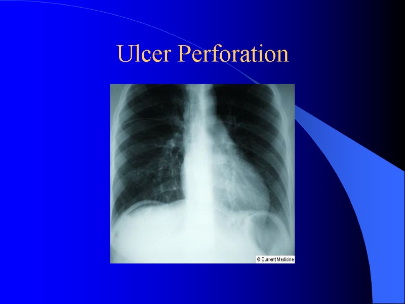 Ulcer Perforation